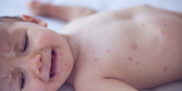 Measles killed 6-week-old baby, coroner confirms after RFK Jr. disputed deaths